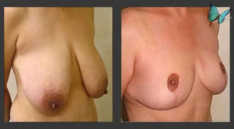 Breast lift with reduction results correcting heaviness and sagging