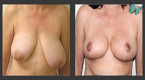 Before and after breast lift and reduction for improved symmetry and posture