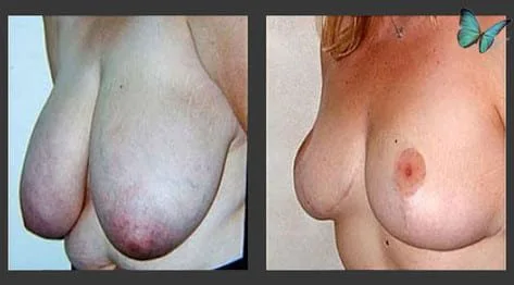 Breast lift with reduction and nipple correction before and after