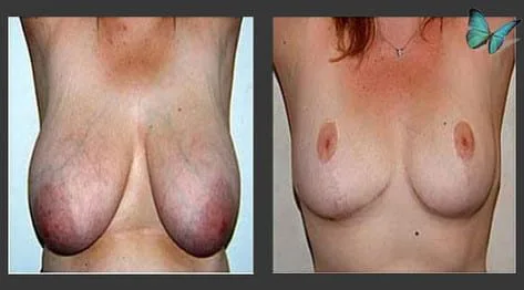 Breast lift with reduction and nipple correction before and after