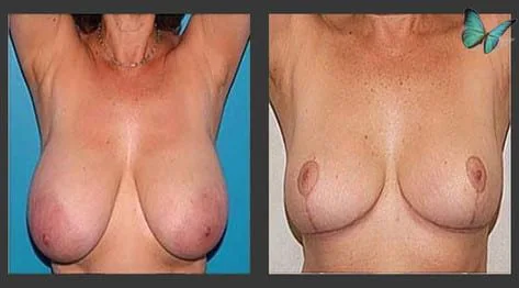 Breast lift and reduction before and after with smaller, more proportionate breasts