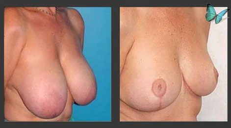 Breast lift and reduction before and after with smaller, more proportionate breasts