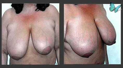 Before and after breast lift and reduction for improved symmetry and posture
