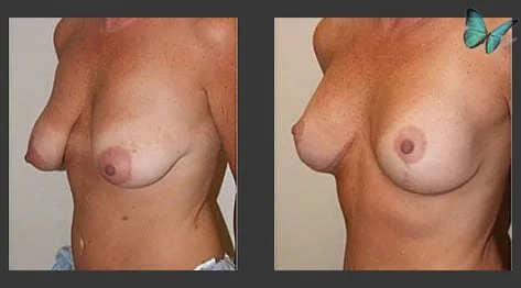 Breast lift transformation addressing drooping after pregnancy