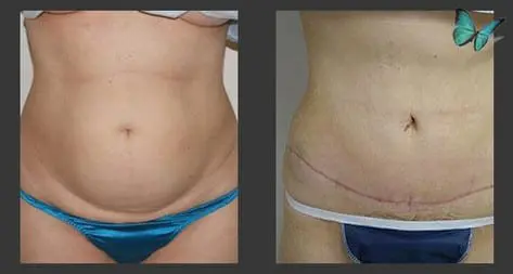 Tummy tuck before and after contouring results for smooth abdominal profile