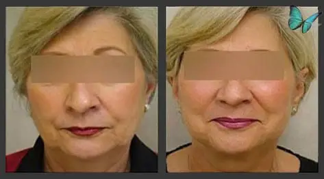 Facelift before and after by Beverly Hills Plastic Surgeon Dr. Malcolm Lesavoy.