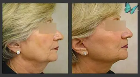 facelift-before-after-3931 Facelift with Neck Lift before and after by Beverly Hills Plastic Surgeon Dr. Malcolm Lesavoy.