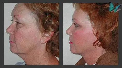 Facelift with Neck Lift before and after by Beverly Hills Plastic Surgeon Dr. Malcolm Lesavoy.