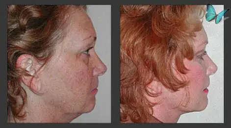 Facelift before and after by Beverly Hills Plastic Surgeon Dr. Malcolm Lesavoy.