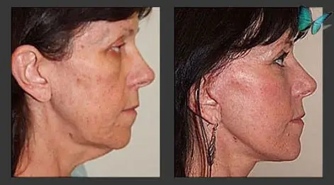 facelift-before-after-3963 Facelift before and after by Beverly Hills Plastic Surgeon Dr. Malcolm Lesavoy.