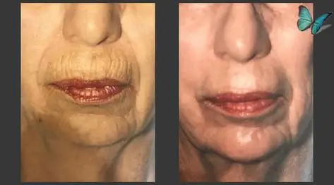 Before and after view of peri-oral region (around the mouth) of a patient that had a facelift and skin resurfacing with chemical peel around the mouth to improve lip lines and wrinkles around the mouth.