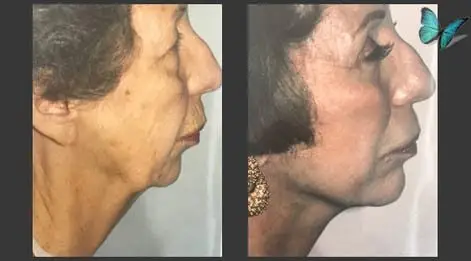 Facelift before and after by Beverly Hills Plastic Surgeon Dr. Malcolm Lesavoy.