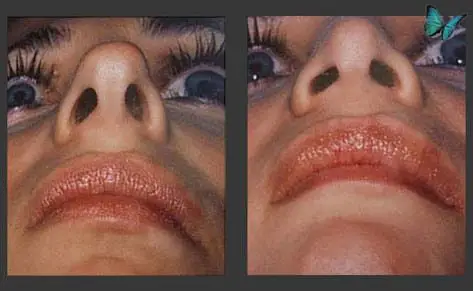 Rhinoplasty before and after photos by Beverly Hills Plastic Surgeon Dr. Malcolm Lesavoy