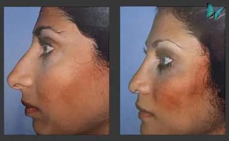 Rhinoplasty before and after photos by Beverly Hills Plastic Surgeon Dr. Malcolm Lesavoy
