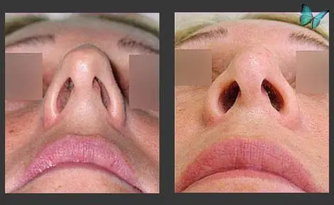 View of columella for a closed rhinoplasty, also called scarless rhinoplasty, by Dr. Malcolm Lesavoy.