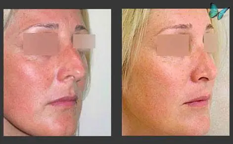 Rhinoplasty before and after photos by Beverly Hills Plastic Surgeon Dr. Malcolm Lesavoy