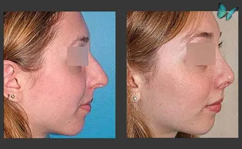 Rhinoplasty before and after photos by Beverly Hills Plastic Surgeon Dr. Malcolm Lesavoy