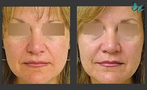 Rhinoplasty before and after photos by Beverly Hills Plastic Surgeon Dr. Malcolm Lesavoy