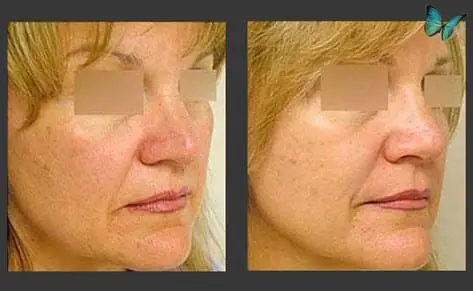 Rhinoplasty before and after photos by Beverly Hills Plastic Surgeon Dr. Malcolm Lesavoy