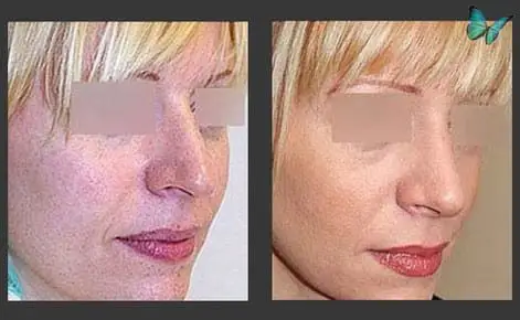 Rhinoplasty before and after photos by Beverly Hills Plastic Surgeon Dr. Malcolm Lesavoy