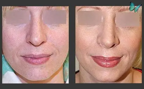 Rhinoplasty before and after photos by Beverly Hills Plastic Surgeon Dr. Malcolm Lesavoy
