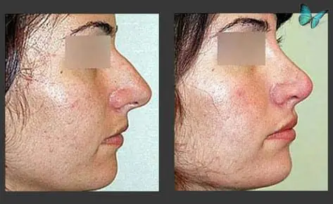 Rhinoplasty before and after photos by Beverly Hills Plastic Surgeon Dr. Malcolm Lesavoy