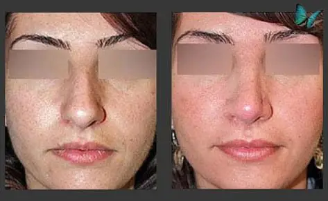 Rhinoplasty before and after photos by Beverly Hills Plastic Surgeon Dr. Malcolm Lesavoy