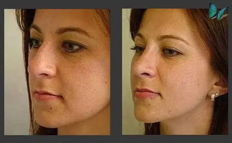 Rhinoplasty before and after photos by Beverly Hills Plastic Surgeon Dr. Malcolm Lesavoy