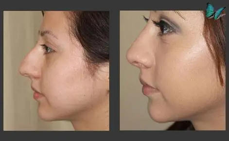 rhinoplasty-before-after-3777 Rhinoplasty before and after photos by Beverly Hills Plastic Surgeon Dr. Malcolm Lesavoy