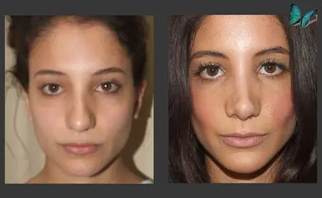 Rhinoplasty before and after photos by Beverly Hills Plastic Surgeon Dr. Malcolm Lesavoy