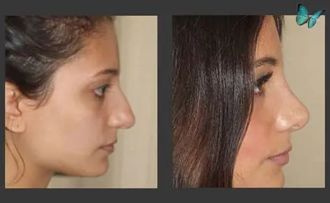Rhinoplasty before and after photos by Beverly Hills Plastic Surgeon Dr. Malcolm Lesavoy