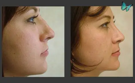 Rhinoplasty before and after photos by Beverly Hills Plastic Surgeon Dr. Malcolm Lesavoy
