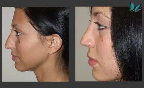 Rhinoplasty before and after photos by Beverly Hills Plastic Surgeon Dr. Malcolm Lesavoy