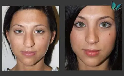 Rhinoplasty before and after photos by Beverly Hills Plastic Surgeon Dr. Malcolm Lesavoy